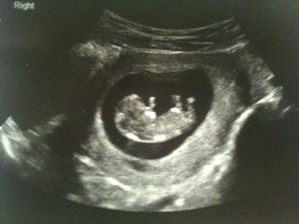 Pregnant Scan 24