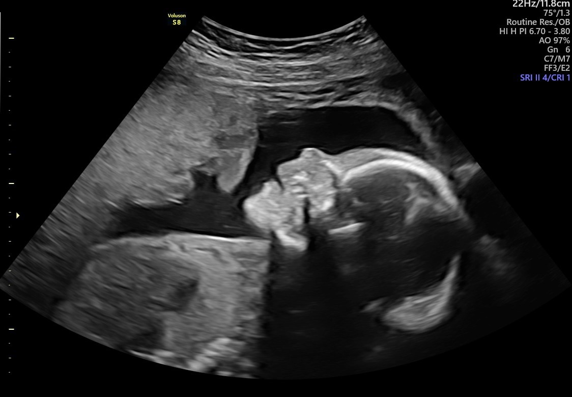 Gender fetal scan from 16wks - Bromsgrove