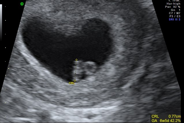 Bromsgrove - early pregnancy scan 6 weeks